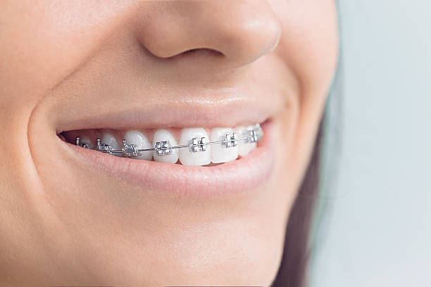 Best Traditional Braces  in Los Osos, CA